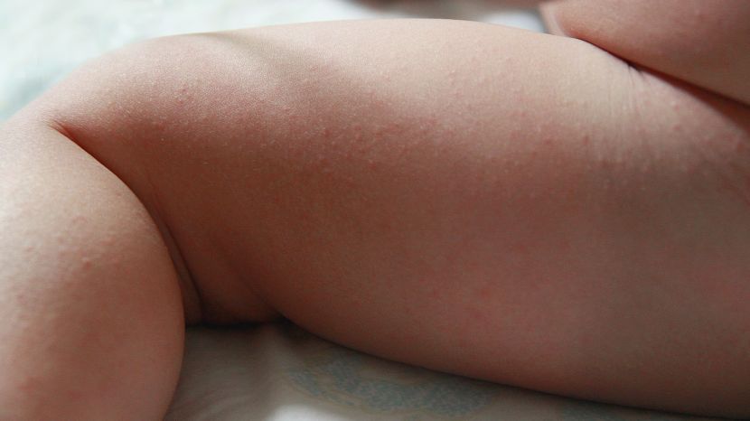 Hitzepickel beim Baby: Was tun?